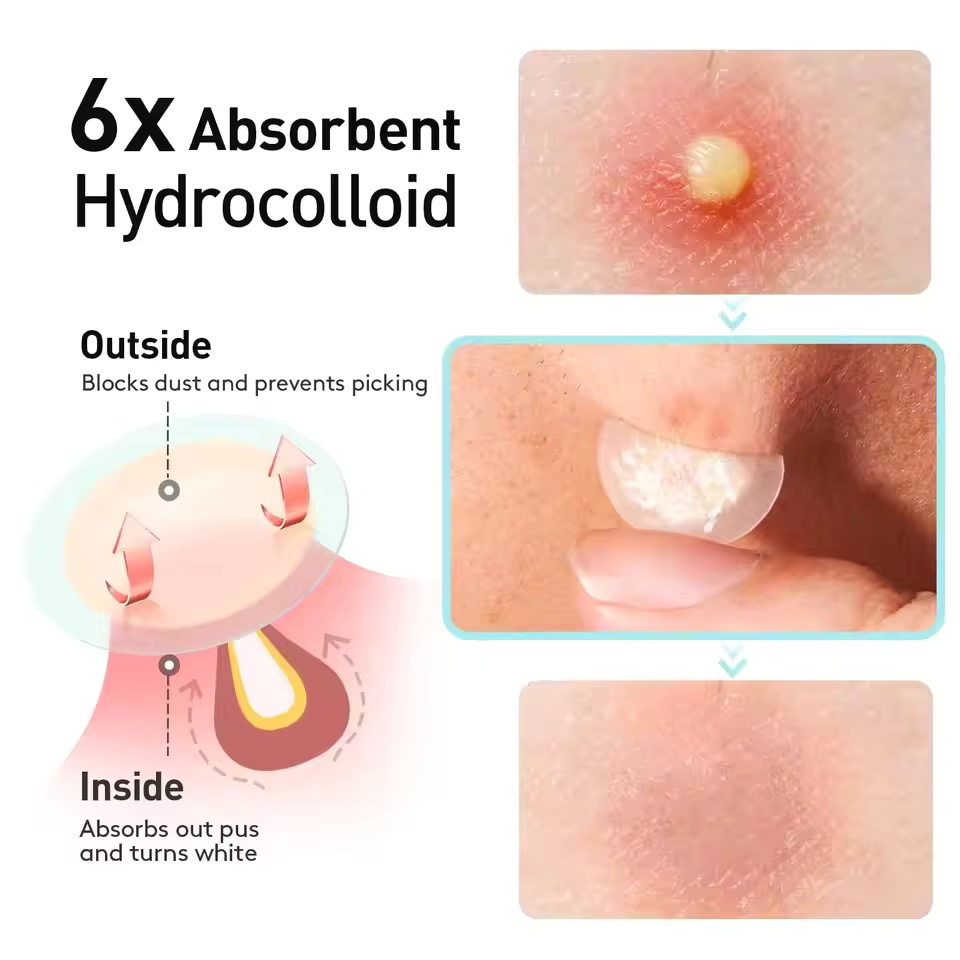 360 pieces/box acne patches -  - Face Oil recension och pris